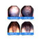Крышки роста волос лазера диода 5mW класса II для выпадения волос